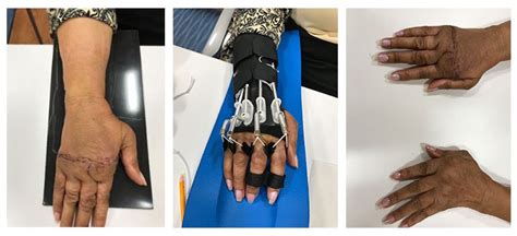 Post Operative Orthosis For Patients With Rheumatoid Arthritis