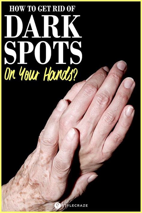 How To Get Rid Of Dark Spots On Your Hands Dark Spots On Skin