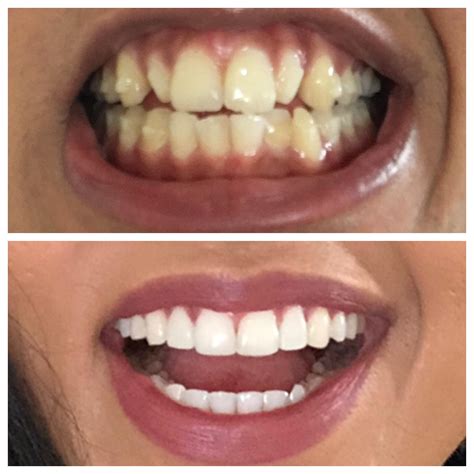 Done 16 Months 1 Set Of Refinement Trays Crest White Strips And