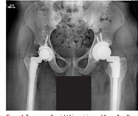 Figure 4 From Pantaloon Hip Spica Cast And Constrained Liner For The Treatment Of Early Total