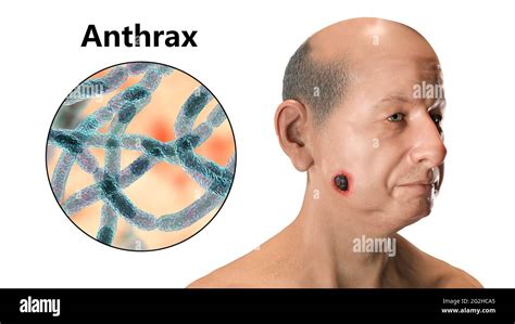 Inhalation Anthrax Fotos Und Bildmaterial In Hoher Auflösung Alamy