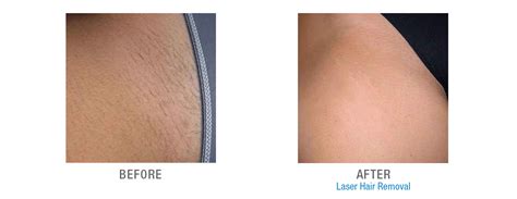 Full Brazilian Laser Hair Removal Before And After