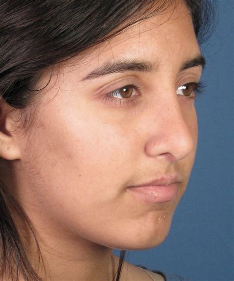 Cosmetic Reshaping Of The Crooked Ethnic Nose Dr Hilinski