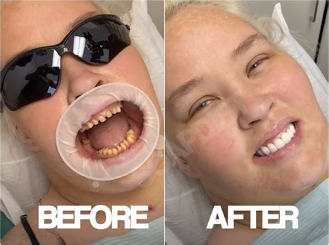 Honey Boo Boos Mama June Replaces Rotten Teeth Before And After Mto News