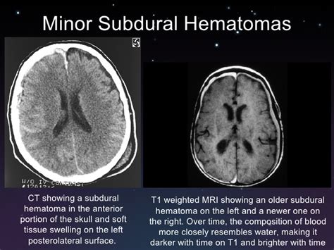 A subdural hematoma is a brain injury which involves blood collecting between the brain and the outermost meningeal part of the brain (called the dura). Subdural And Epidural Hematomas