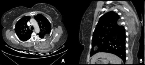 Ct Scan Showing Chest Wall Angiomatosis Lesion With Intrathoracic