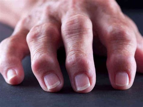 Болят суставы пальцев рук причины диагностика и лечение Athletic