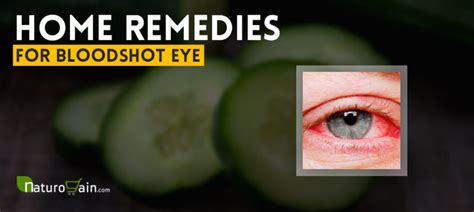 10 Best Home Remedies For Bloodshot Eye To Prevent Red Eyes Fast