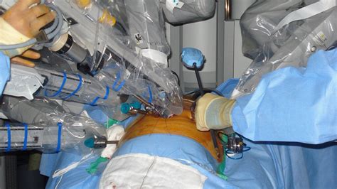7 Most Frequently Asked Questions About Robotic Prostatectomy