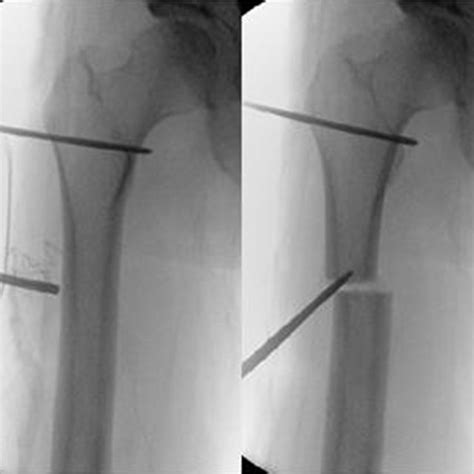 Postoperative Imaging X Ray Figure 3 Drill Hole Osteotomy