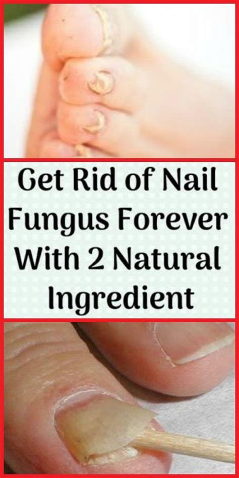Get Rid Of Nail Fungus Forever With 2 Natural Ingredient Toenail