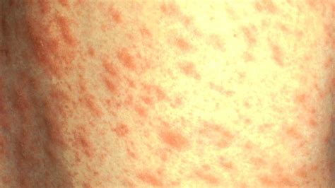 Is That Rash Psoriasis Psoriasis Pictures And More