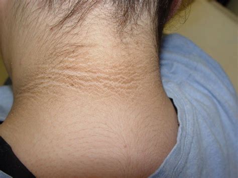 What Causes Acanthosis Nigricans 13 Possible Causes You Should Know