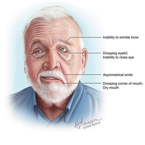 Facial Nerve Palsy Causes Symptoms Treatment Facial N Vrogue Co