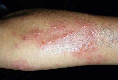Allergic Contact Dermatitis Poison Ivy