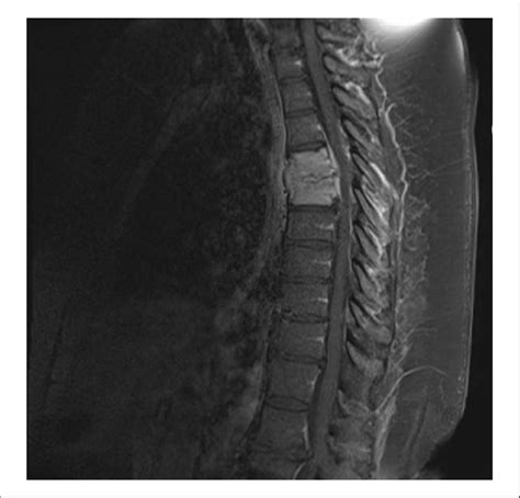 Sagittal T2 Mri Post Contrast Image Of The Patients Thoracic Spine