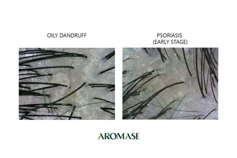 What Does Dandruff Psoriasis Look Like Pictures Symptoms Must Do