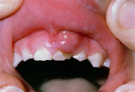 Dental Abscess In Child Photograph By Dr P Marazziscience Photo Library