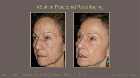 View The Before And After Gallery For Ablative Fractional Resurfacing