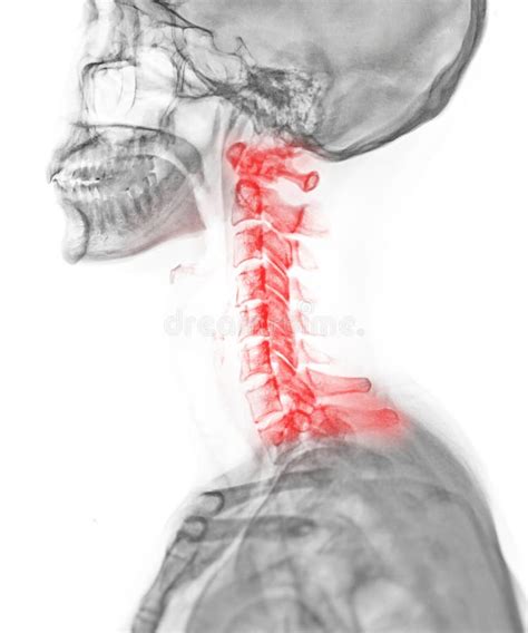 X Ray C Spine Or X Ray Image Of Cervical Spine Lateral View For