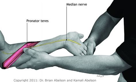 Pronator Teres And Median Nerve Median Nerve Carpal Tunnel Relief