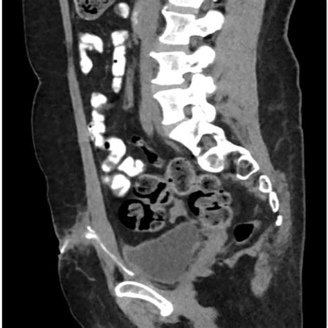 Fistulogram Showing Extension Of Sinus Tract From Suprapubic Incision