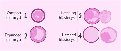 What Does Assisted Hatching Aha Mean In Ivf