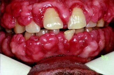 Tooth infection can be any kind of infection that affects the tooth and some parts of the oral cavity like the gums around the teeth. Bleeding gums. Causes, symptoms, treatment Bleeding gums