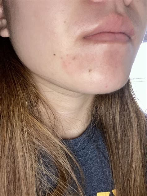 Mild Eczema And Acne Proneoily Skin Pictures General Acne