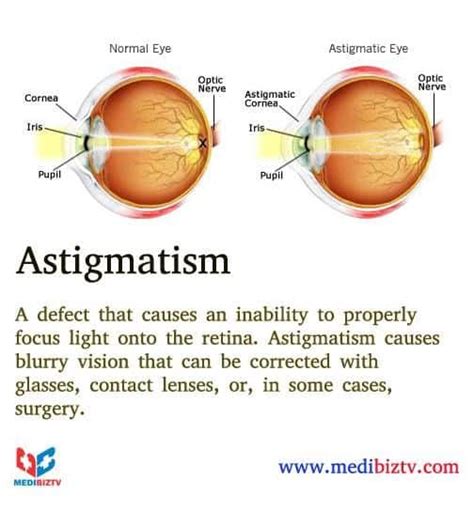 Can Astigmatism Go Away Naturally Astigmatism Glaucoma Swollen Eyes