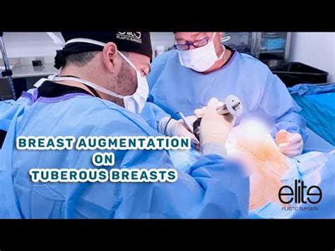 Breast Augmentation On Tuberous Breasts Dual Plane Lift YouTube