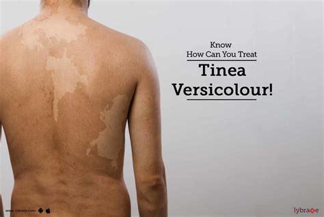 Know How Can You Treat Tinea Versicolour By Skinovate Laser And Cosmetic Surgery Lybrate