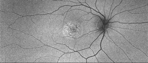 03 Unilateral Acute Idiopathic Maculopathy Uaim Faf Od Retina