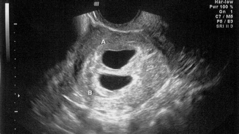 What To Expect For Ultrasound At 4 Weeks Pictures And Videos New