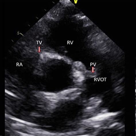 Pdf Isolated Pulmonic Valve Endocarditis Case Report And Review Of