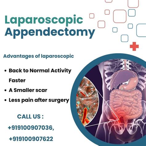 Laparoscopic Appendectomy Appendix Removal Medintu