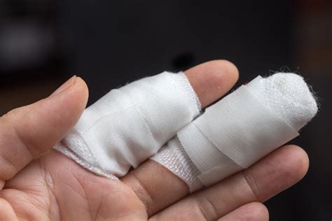 Can Broken Finger Be Reconnected Singapore Sports Clinic