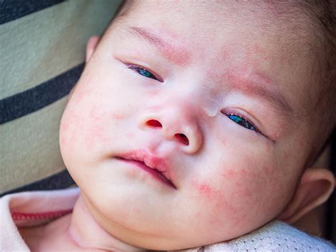 婴儿湿疹的诊断治疗研究进展医疗科普百康医疗