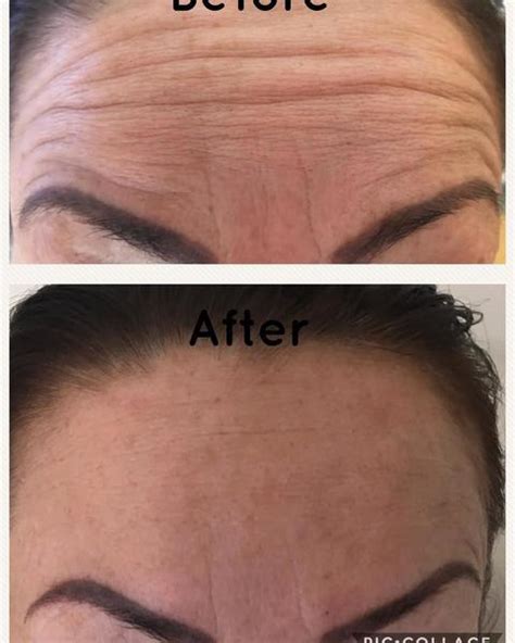 Botox Lines In Forehead Before And After 2 Facial Injections Info