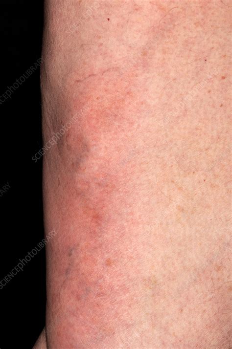 Superficial Phlebitis Stock Image M1750557 Science Photo Library