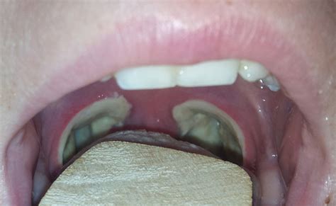 Best Tonsillectomy Recovery Images Tonsillectomy R Vrogue Co
