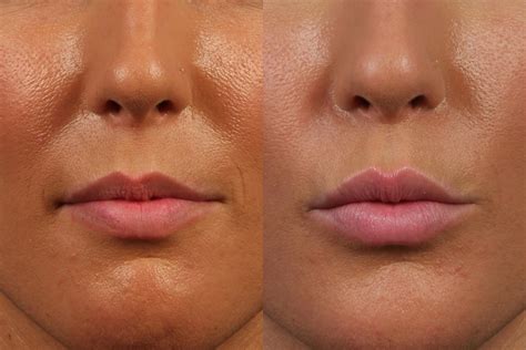 Avoid Lip Filler Mistakes Dr Brett Kotlus Cosmetic Oculoplastic