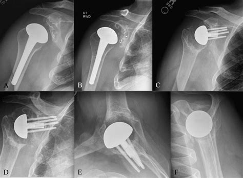 Reverse Hemiarthroplasty What Happens When A Patient Forgoes The