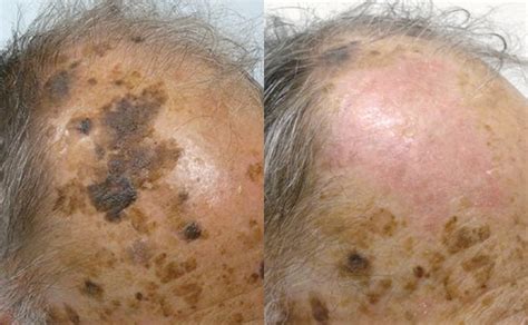 Seborrhoeic Keratosis Removal From £345 Leeds Bradford Harrogate