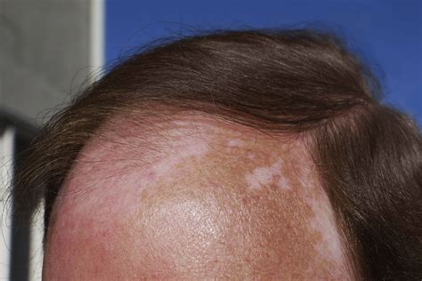 Sun Spots On Skin Cancer Images