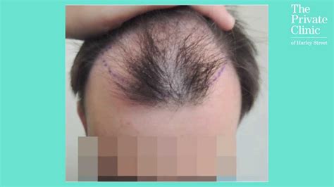 Hair Transplant Before After Fue Follicular Unit Extraction Hair
