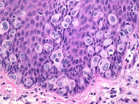 240 breast disorders, fibrocystic disease, mammary duct ectasia, usmle step 1, usmle ace. Webpathology.com: A Collection of Surgical Pathology Images