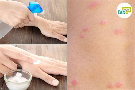 How To Treat Bed Bug Bites Top 10 Home Remedies Fab How