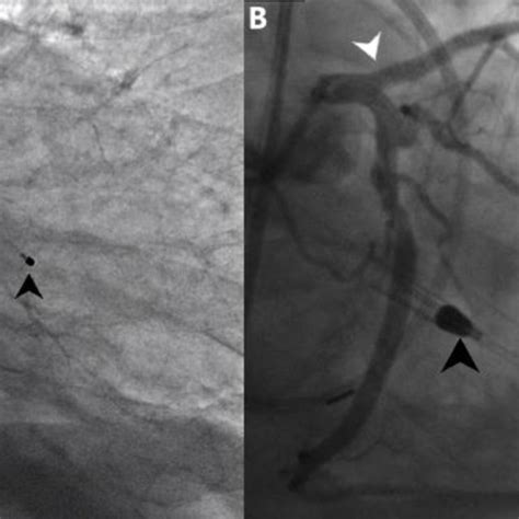 Left Heart Catheterization A Cardiac Catheterization Showing