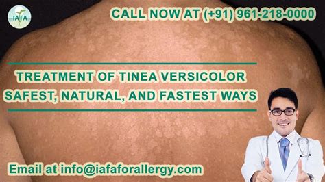 Treatment Of Tinea Versicolor Safest Natural And Fastest Ways Youtube